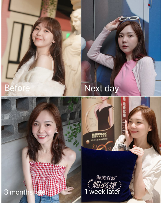 【海芙電音雙波】療程對比：狀態有目共睹，找回屬於自己的精緻通行證